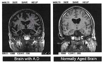 Early Detection And Prevention Of Alzheimers Genetics Lifestyle