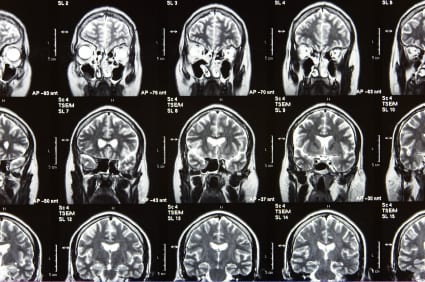 Imaging of several brain scans